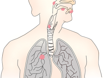 빠르게 증가하고 있는 역류성 식도염